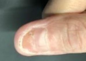 Beau’s lines