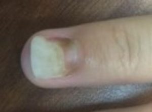 Oncholysis